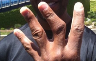 20 Athletes With Unbelievably Messed Up Fingers