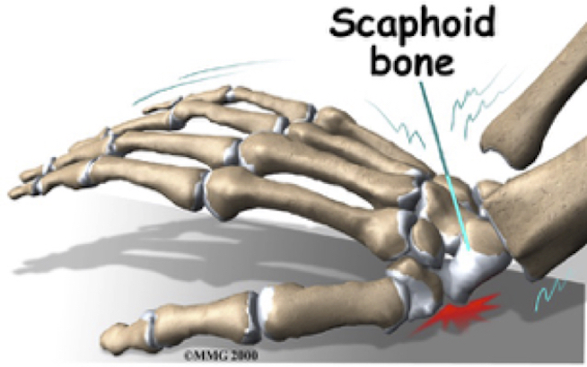 Scaphoid Bone