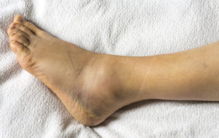 close up image of a sprained ankle